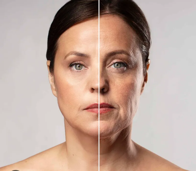 HIFU 25D face lifting treatment