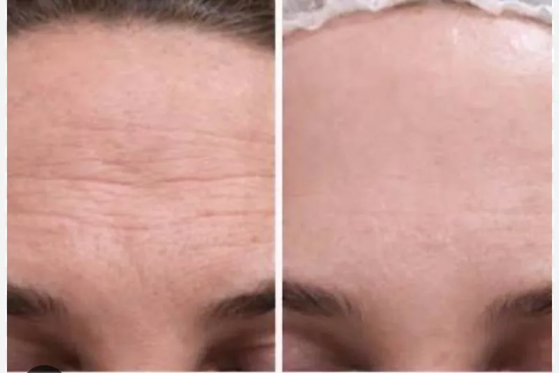 HIFU 25D treatment results