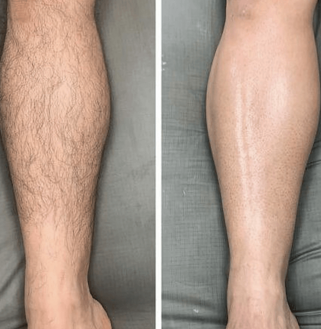 Advanced laser hair removal session