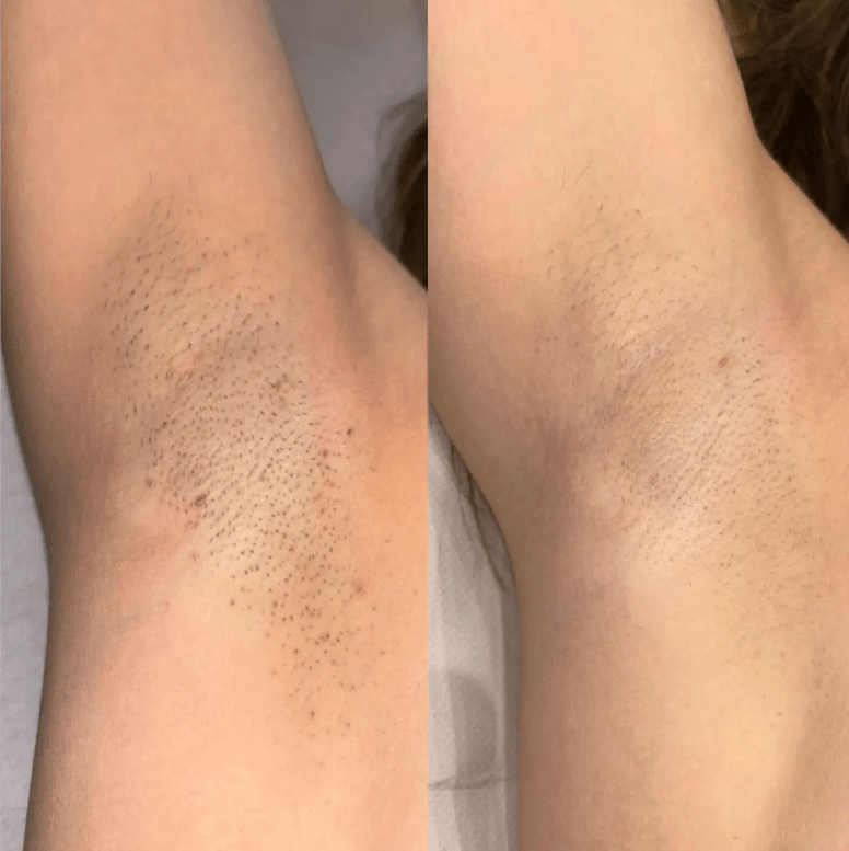 Professional laser hair removal treatment