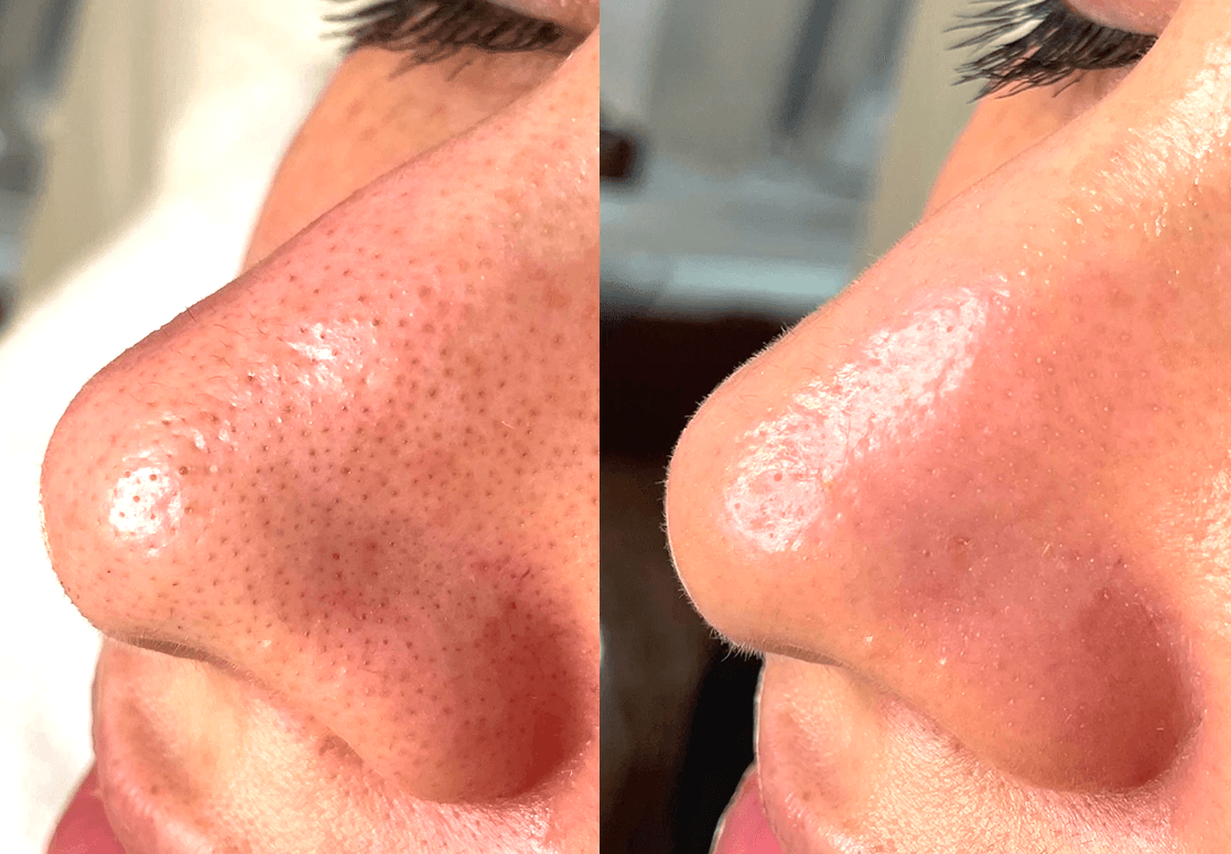 Advanced facial treatment