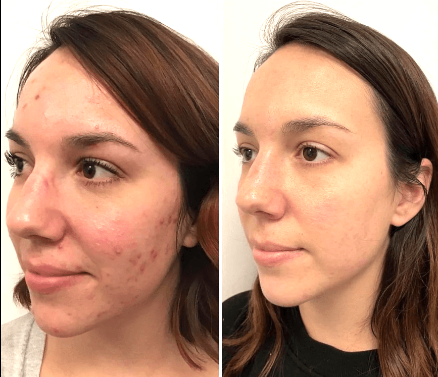 Facial therapy treatment