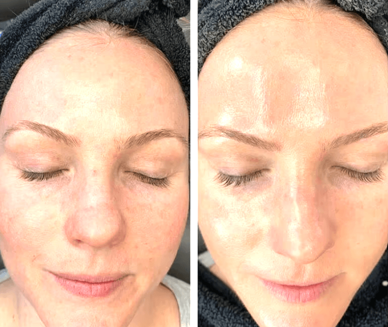 Professional skincare procedure